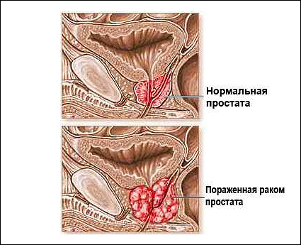 Рак простаты
